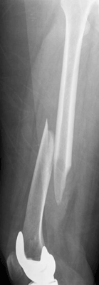 Femoral shaft fracture above a well-fixed TKR