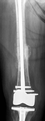 retrograde femoral nail