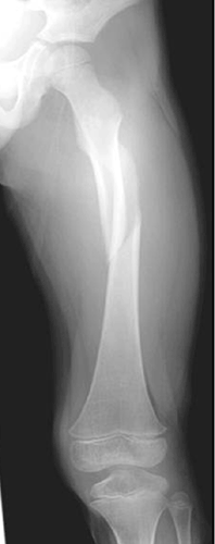 length-unstable femur fracture