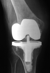 right supracondylar femur fracture