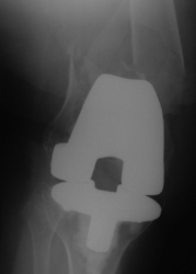 right supracondylar femur fracture