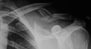 severely comminuted midshaft clavicle fracture