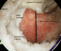 Closing or repairing a longitudinal capsulotomy