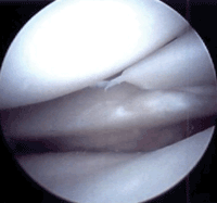 posterior lateral meniscus