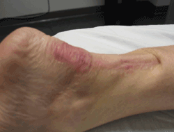 Achilles tendon rupture