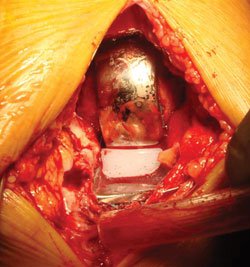 An abbreviated medial parapatellar arthrotomy for medial mobile bearing UKA