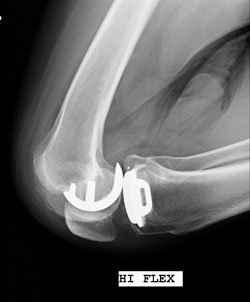 A high-flexion lateral radiograph