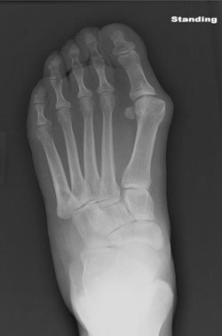 A preoperative AP-standing view of a left foot