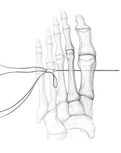 Preparation for passage of the 2-0 suture-wirea left foot