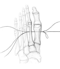 The configuration is shown following pulling of both the suture-wire and the nylon loop