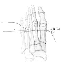 Preparation for passage of the suture-wire back across the first and second metatarsals