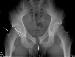 AP pelvis of a collegiate soccer player with FAI and athletic pubalgia