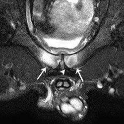 Coronal oblique T2-weighted  MR image