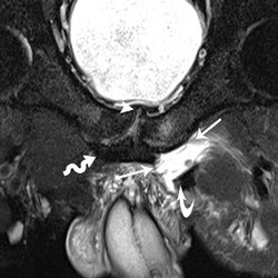 Coronal oblique T2-weighted fat suppressed MR image from an athletic pubalgia MRI on a 27-year-old 