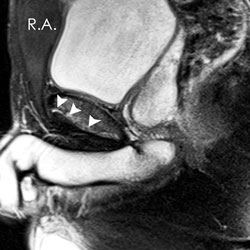 Sagittal T2-weighted fat suppressed MR image from a 20-year-old