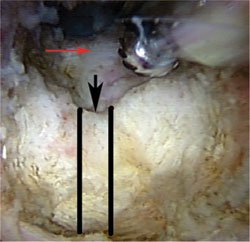 View from snterior pubic portal