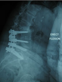 Flexion plain X-ray of the lumbar spine of an 81 year-old woman, 2 years following L3-S1 posterior lumbar interbody fusion.