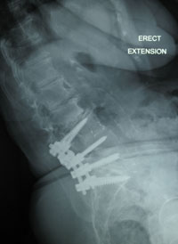 Extension plain X-ray of the lumbar spine of an 81 year-old woman, 2 years following L3-S1 posterior lumbar interbody fusion.