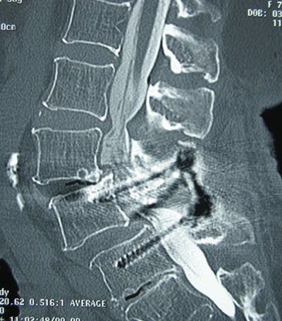 CT myelogram of a 75 year-old woman suffering claudicant back and leg pain.