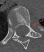 CT scan of a type C pedicle