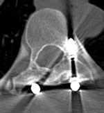 CT of the same vertebra with a Type D pedicle