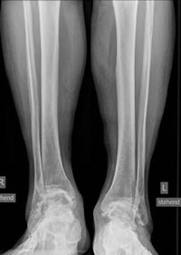 AP radiographs showed painful bilateral ankle osteoarthritis in a 64-year-old man.