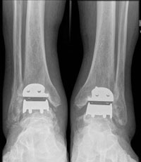 AP radiograph shows the prosthetic components were properly positioned in both ankles at 2.2 years after surgery