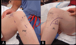 skin incisions