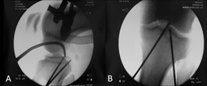 intraoperative radiographs