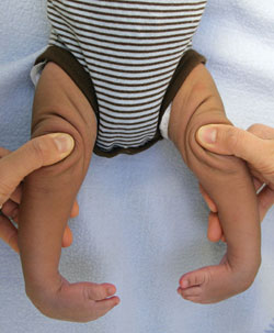 Infant with idiopathic clubfoot.