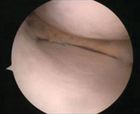 Arthroscopy image at 1 year post-implantation of the Actifit (Orteq).