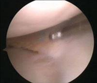 Second look arthroscopy image at 1 year post-implantation of the Actifit (Orteq).