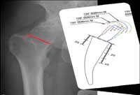 AP  lateral radiographs of the hip are templated with a femoral neck cut