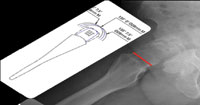 Frog leg lateral radiograph of the hip are templated with a femoral neck cut