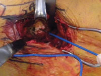 Two Homan-type retractors are placed behind the posterior wall 