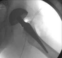 AP fluoroscopic image of a THA 