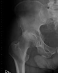 Postoperative radiographs show a THA performed through a direct anterior approach using a metaphyseal bone-sparing stem.