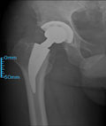 Postoperative radiographs show a THA performed through a direct anterior approach using a metaphyseal bone-sparing stem.