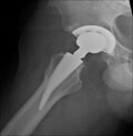 Postoperative radiographs show a THA performed through a direct anterior approach using a metaphyseal bone-sparing stem.