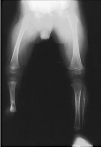 APradiograph of a 14-month-old boy with FH and fixed equinovalgus foot deformity