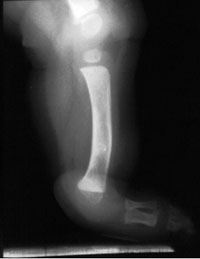 Lateral radiograph of a 14-month-old boy with FH and fixed equinovalgus foot deformity