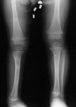 AP radiograph after 6-cm lengthening and superankle surgery for foot deformity correction at age 18 months. There is near equalization of limb length 