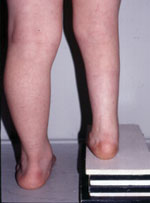 Photograph of foot from behind at age 8 years. There is no recurrence of foot deformity.