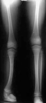 Standing AP radiograph at age 8 years showing leg length discrepancy before the second lengthening surgery.