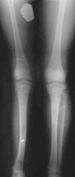 Standing AP radiograph after an 8-cm lengthening at age 8 years.