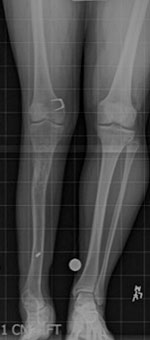 Standing AP radiograph after an 8-cm lengthening at age 16 years.