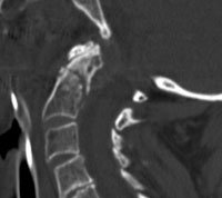 This mid-sagittal CT reconstruction demonstrates mild displacement of an odontoid fracture