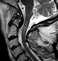 Extensive T2 signal change in the spinal cord is demonstrated