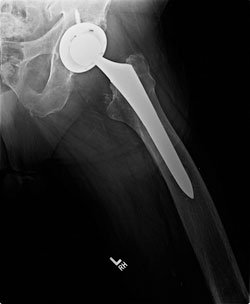 Lateral X-ray shows excellent bone ingrowth and no stress shielding at the 5-year postoperative point.