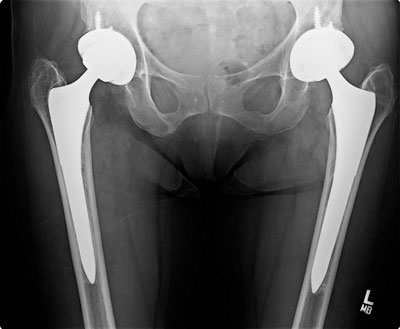 AP pelvis type C bone with good position of stems. There is no stress shielding at the 5-year postoperative point.